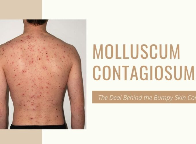 Molluscum-Contagiosum-1 Molluscum-Contagiosum-1