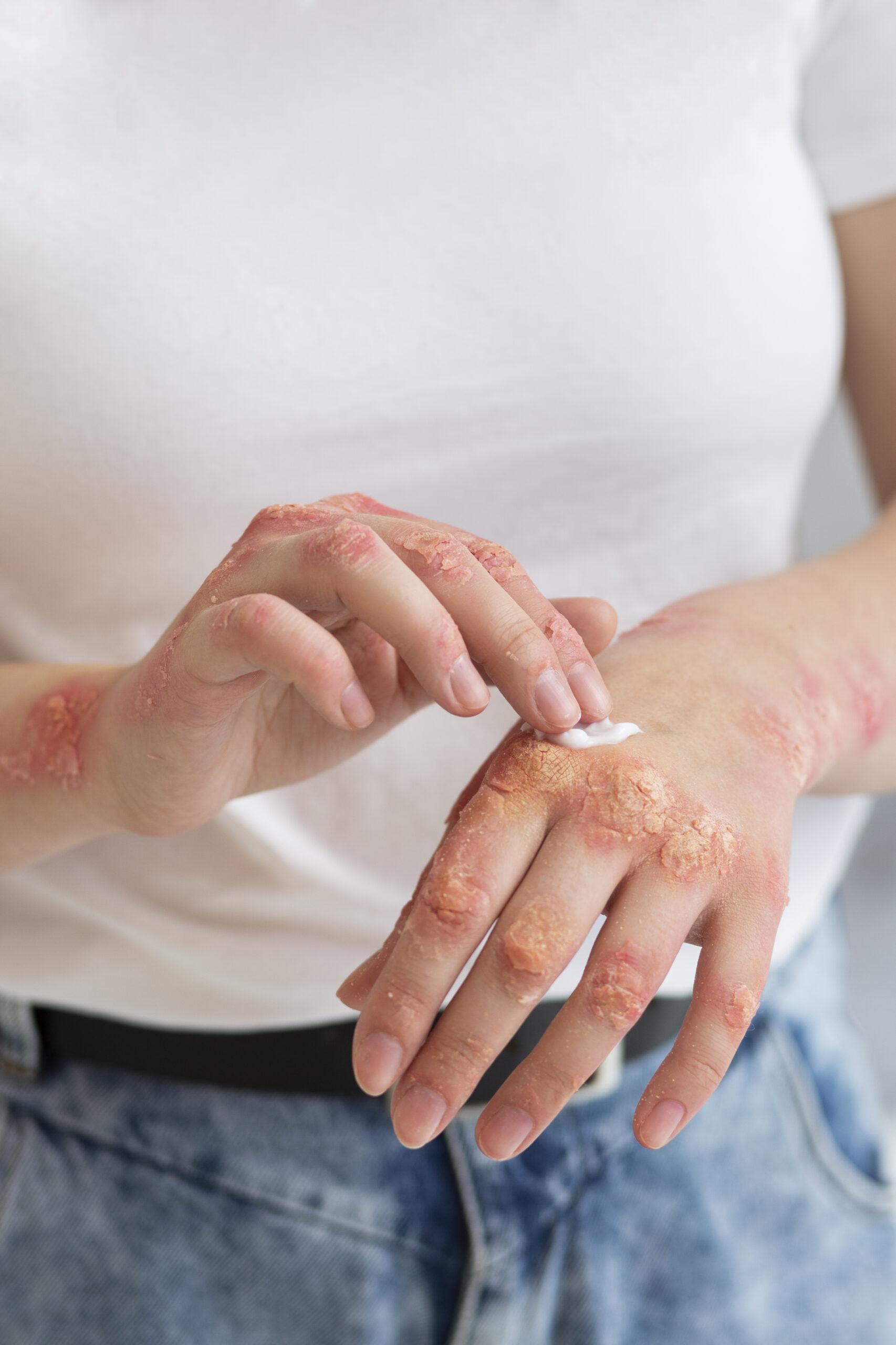 hands-patient-suffering-from-psoriasis (1)