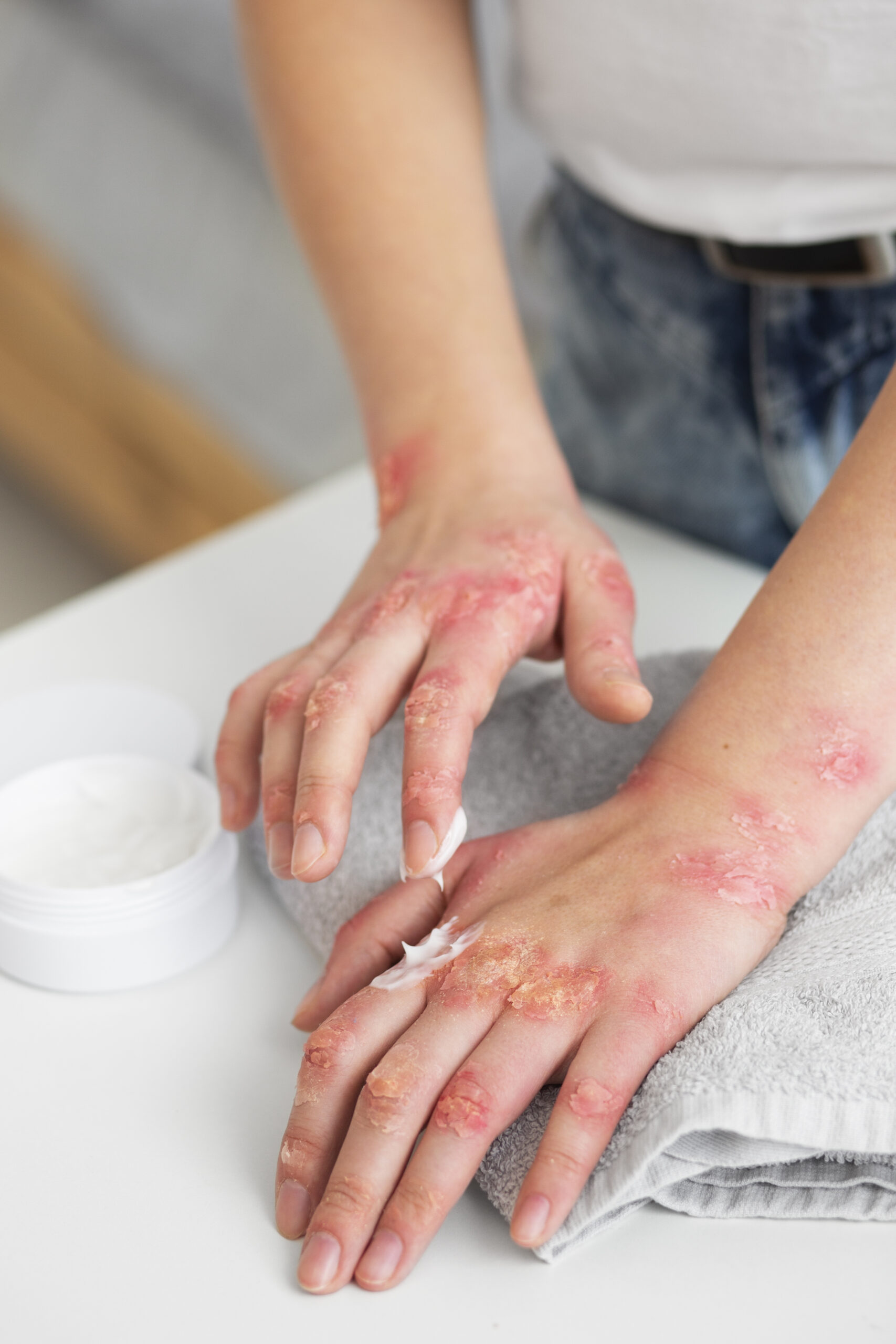 hands-patient-suffering-from-psoriasis (2)
